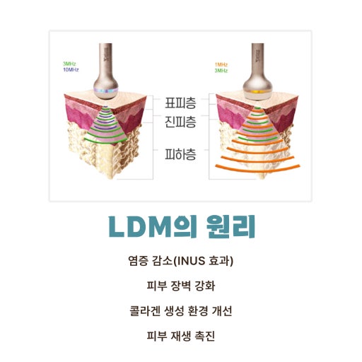 LDM 물방울 리프팅